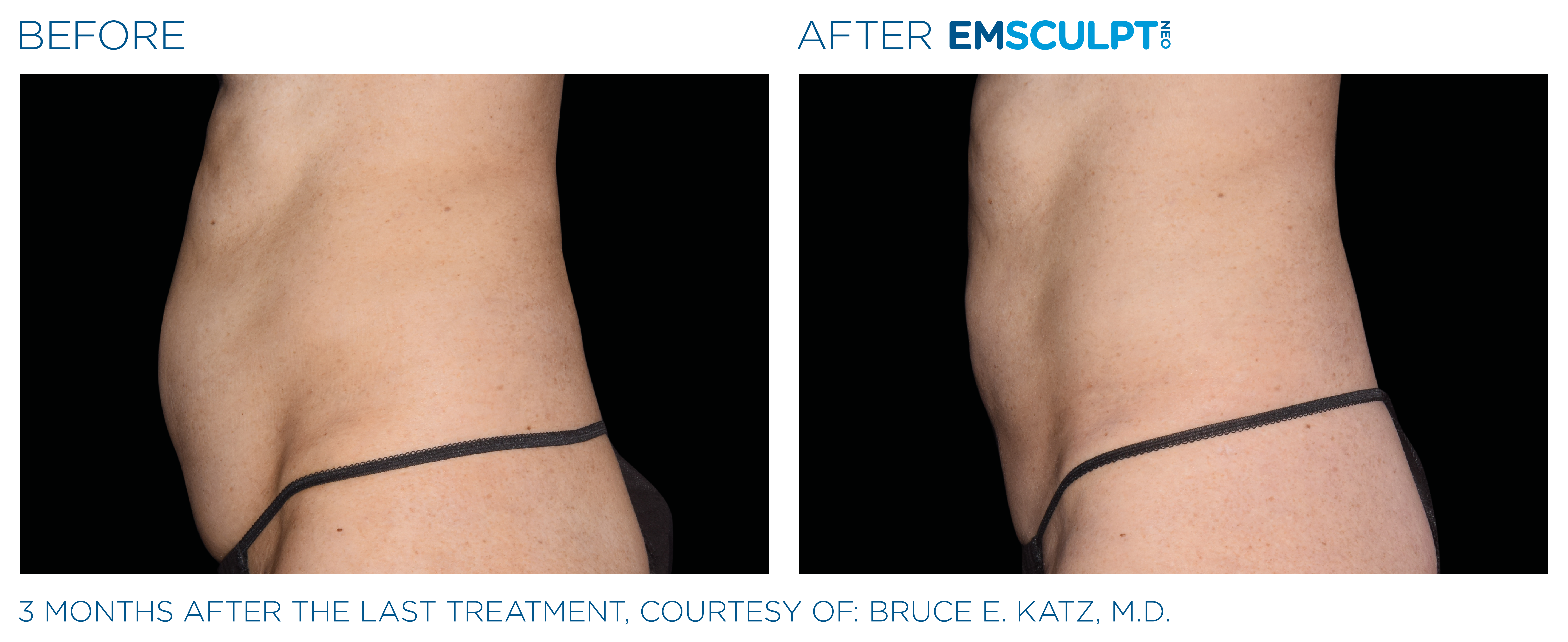 Female abdomen before and after Emsculpt NEO body sculpting.