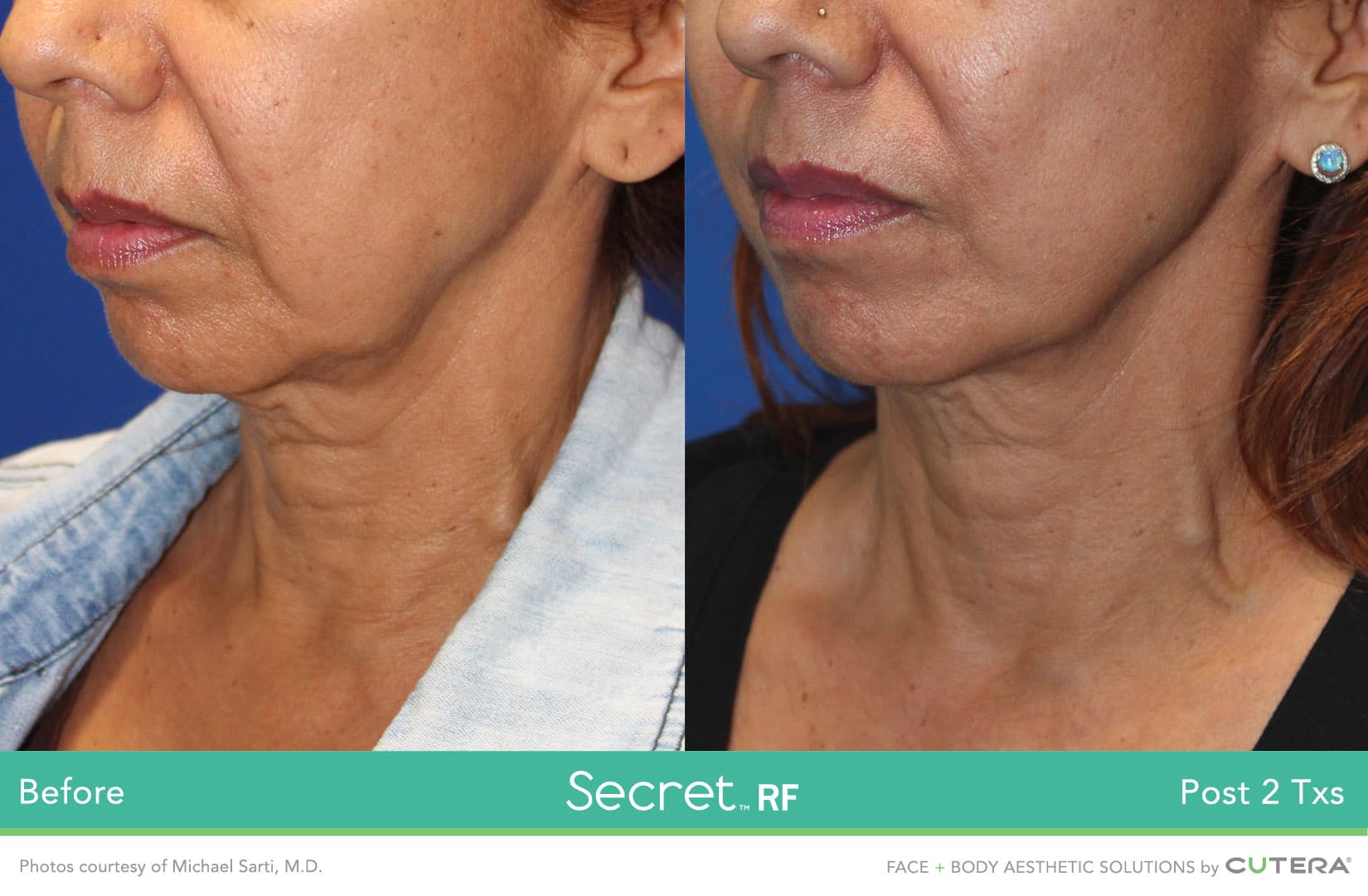 Before & after of woman's face after Secret RF microneedling.