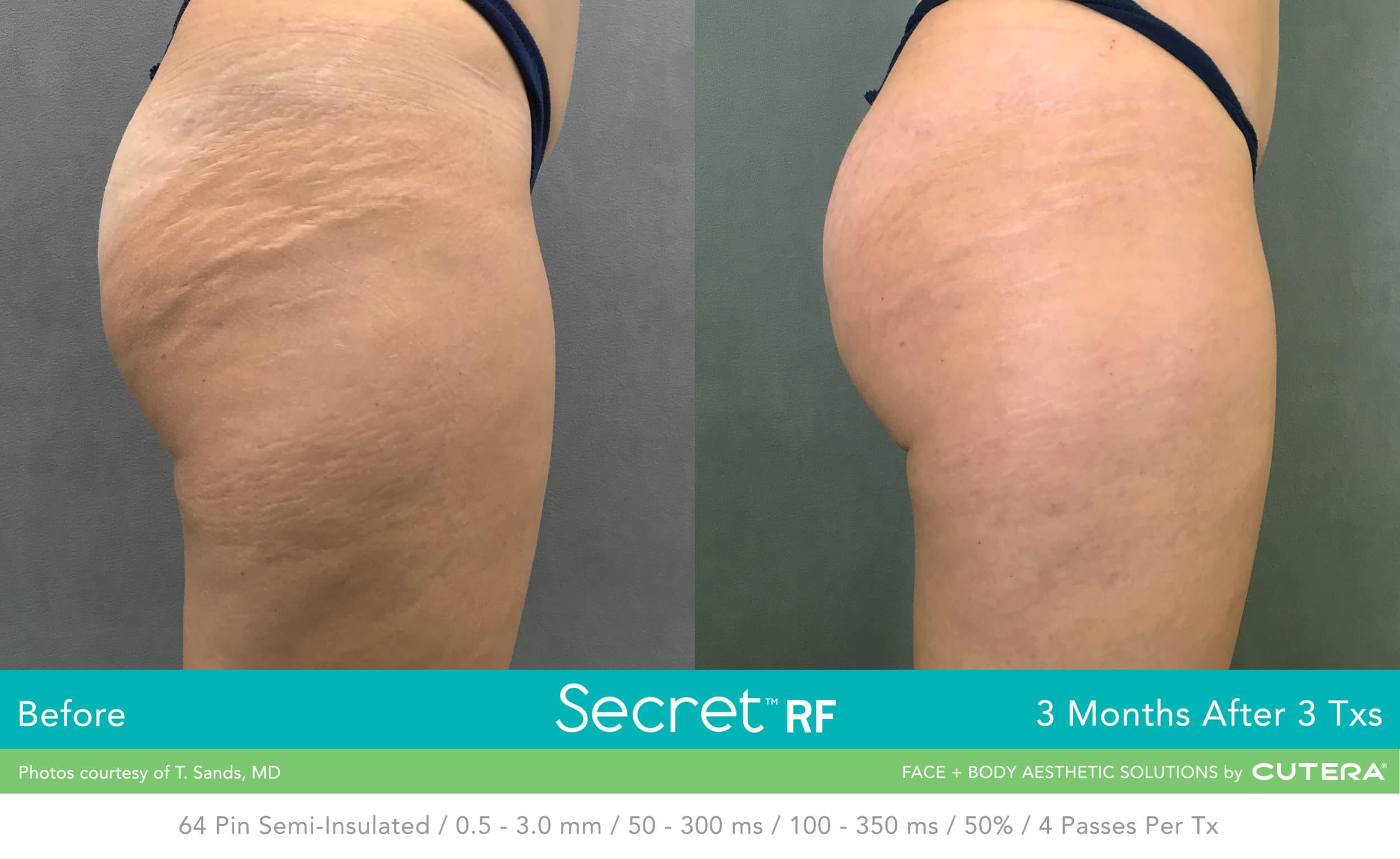 Before & after of woman's legs after Secret RF microneedling.