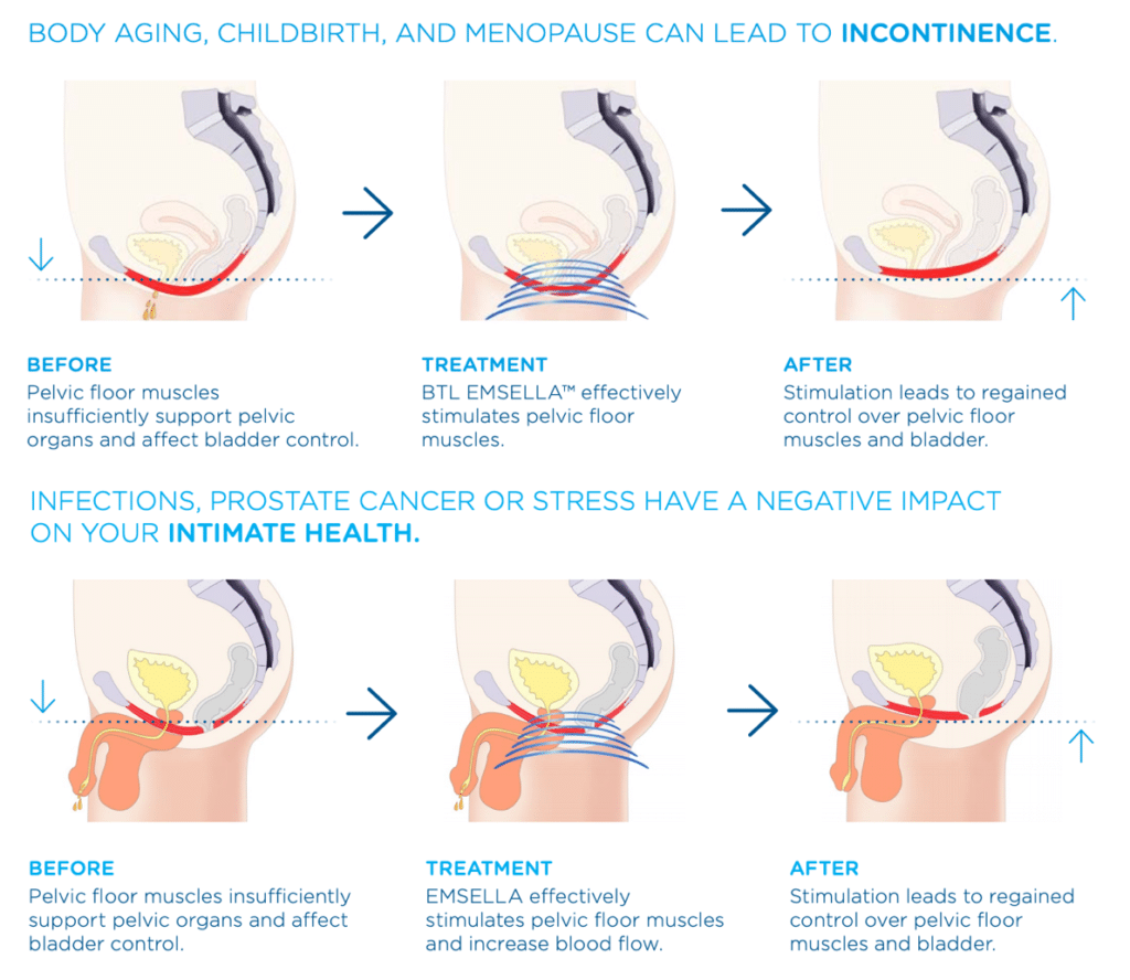 Emsella® Incontinence Treatment Buckner Vein And Aesthetics