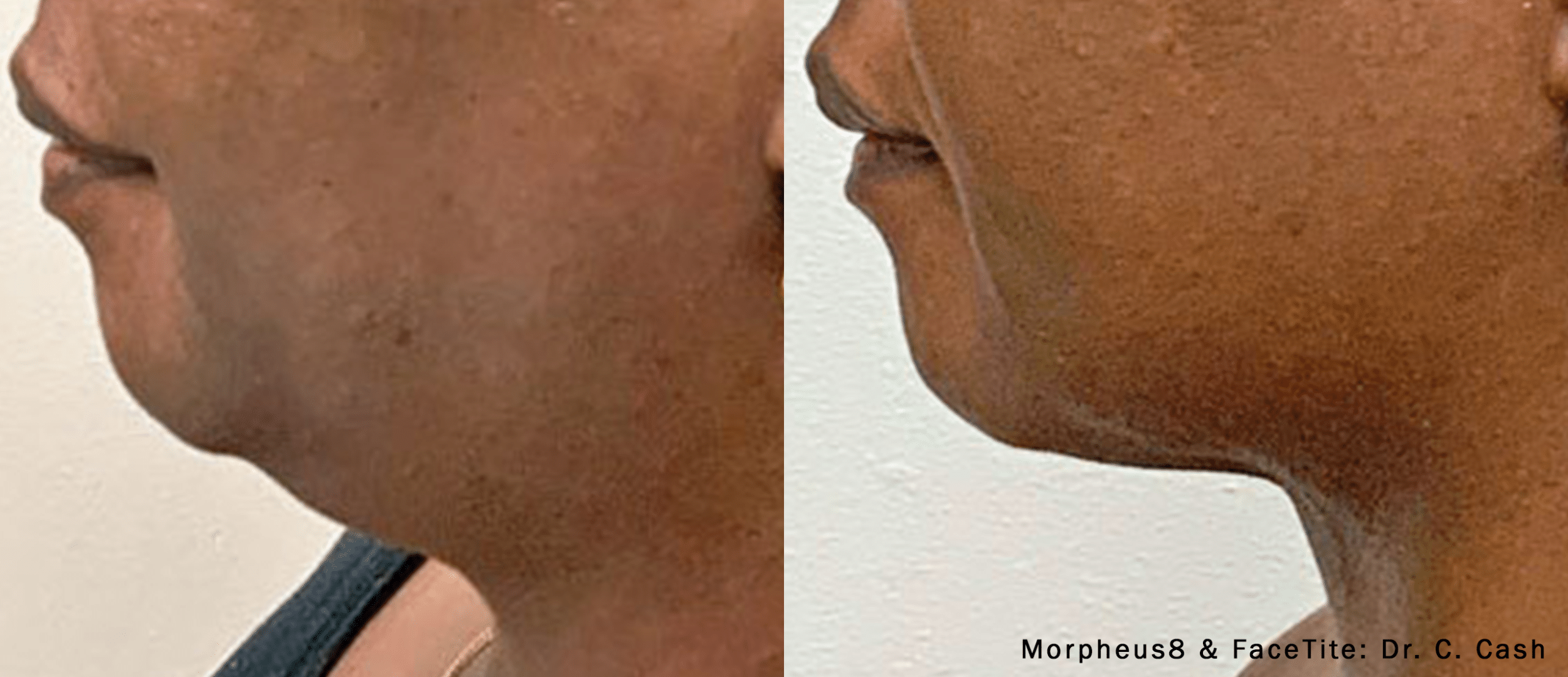 CC Morpheus8FaceTite 1bleftprofile ChinNeck 1