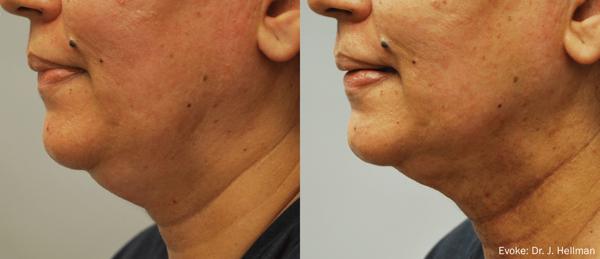 Evoke Face and Neck Contouring – DR. MARIE