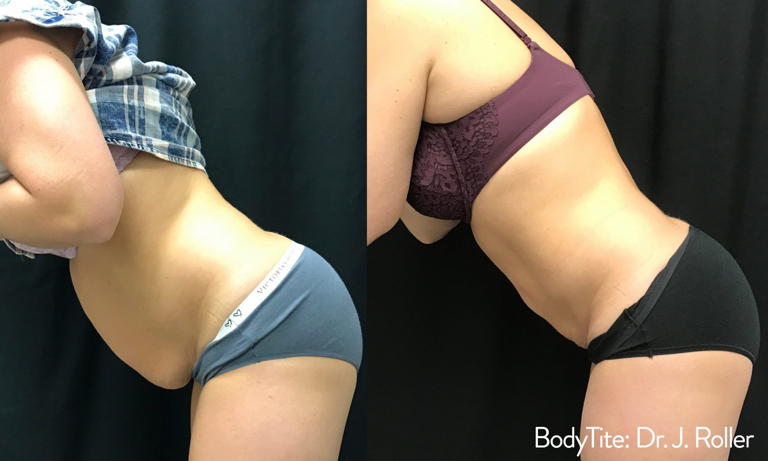 BodyTite: The Ultimate Guide to Radiofrequency Body Sculpting