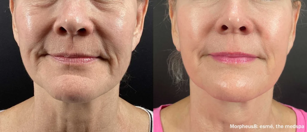 EsmeMedspa Morpheus8 Before After 4Treatments Front TM 2.webp