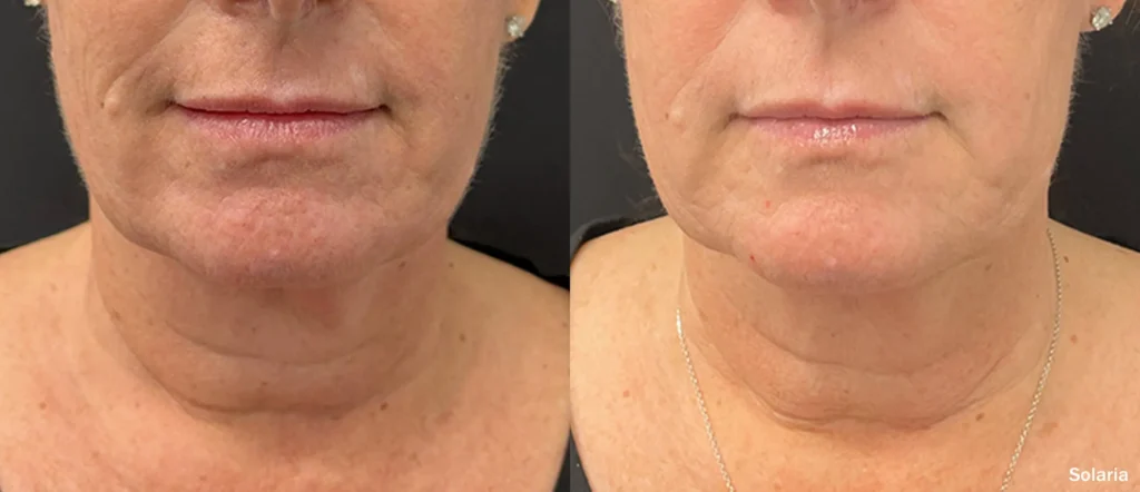 INMD Solaria Face Female Front TM 1.webp