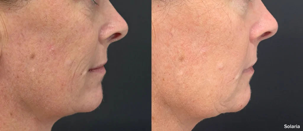 INMD Solaria Face Female RS Zoom TM 1.webp