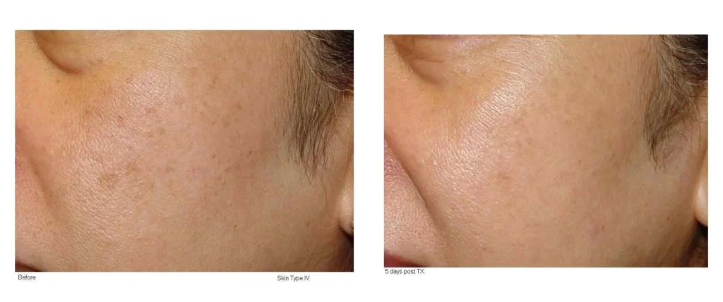 LF Chk Cutera 02 B 0wks left side.webp