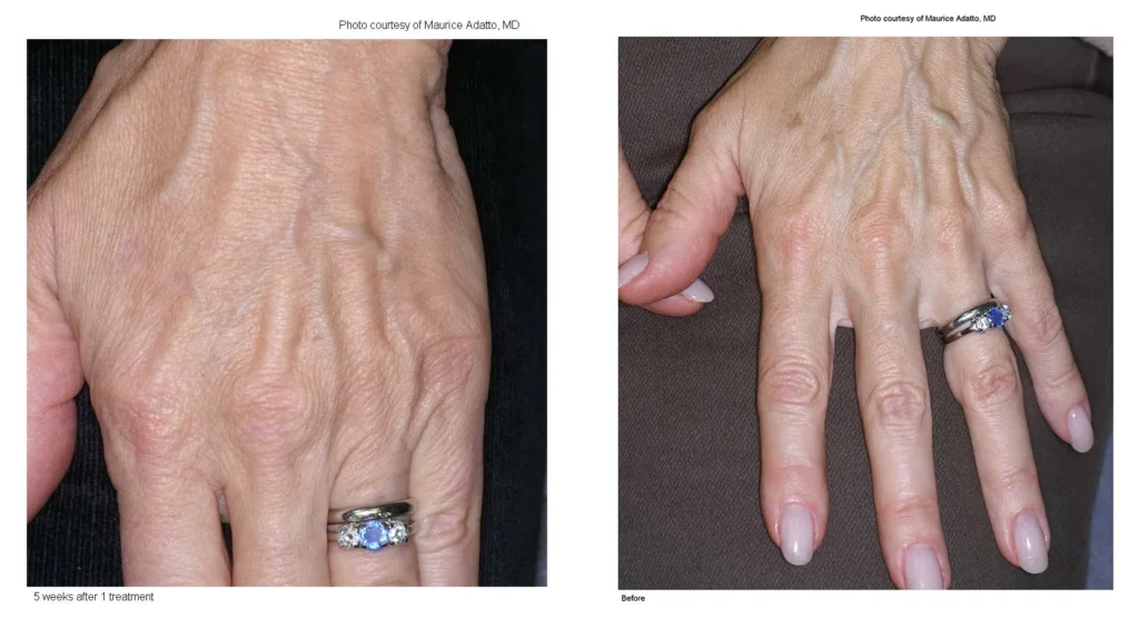 LF hand Adatto 01 1A 5wks left.webp