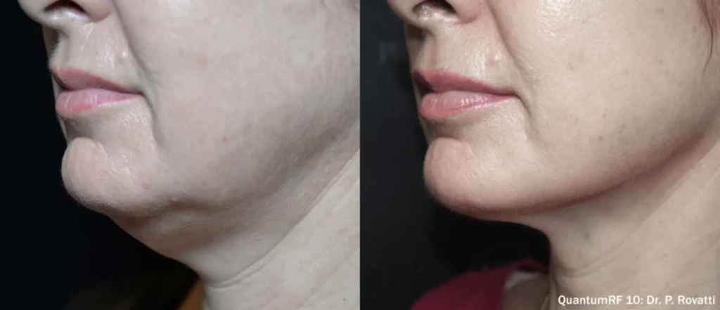 Quantum10 BA 4 1.webp