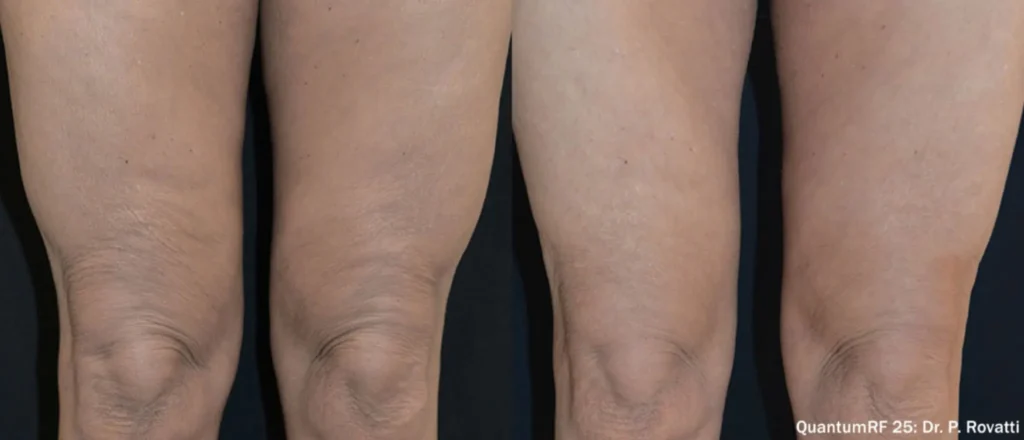 Quantum25 BA 2 2.webp