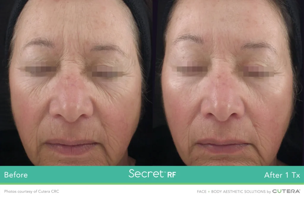 SecretRF Cutera CRC P1 highres scaled.webp