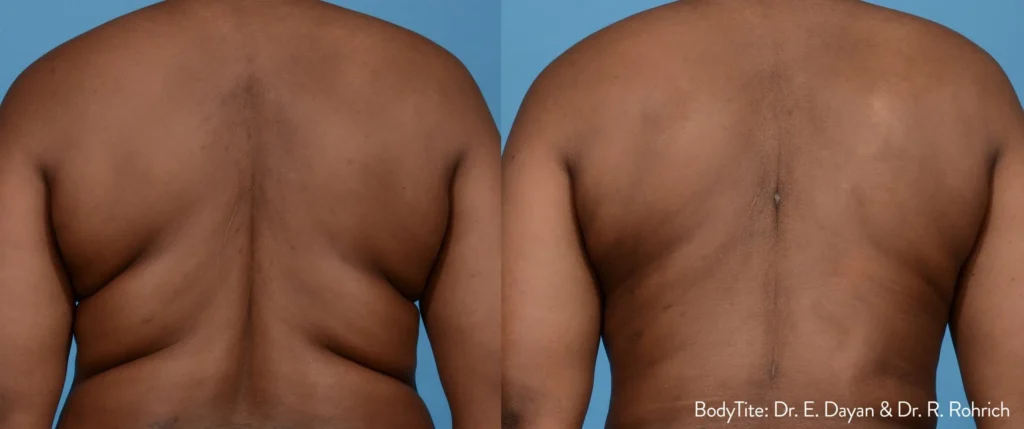 bodytite before after back dr e dayan dr r rochrich preview 1 1.webp