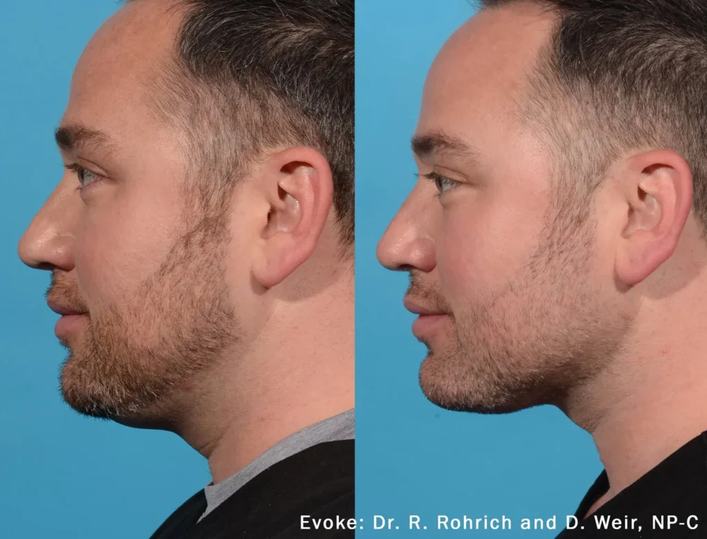 evoke before after dr r rorich dr d weir preview 1.webp