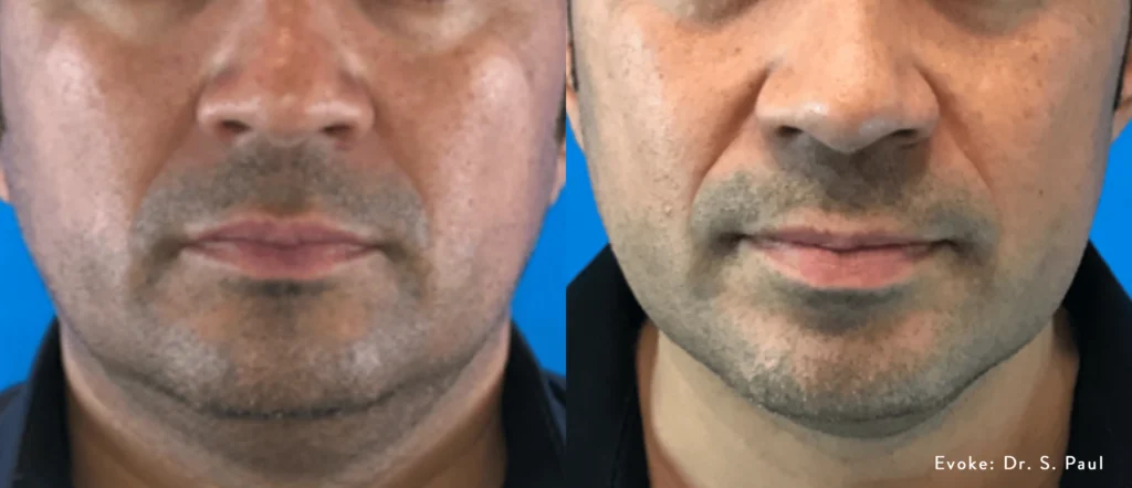 evoke before after dr s paul preview 9.webp