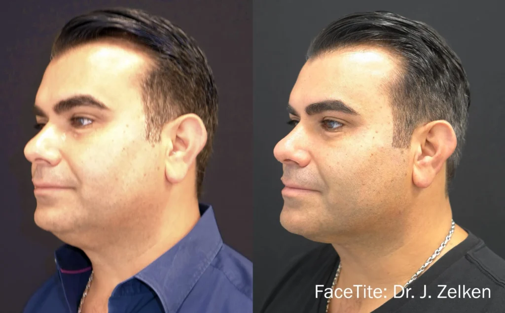 facetite before after dr j zelken preview 1.webp