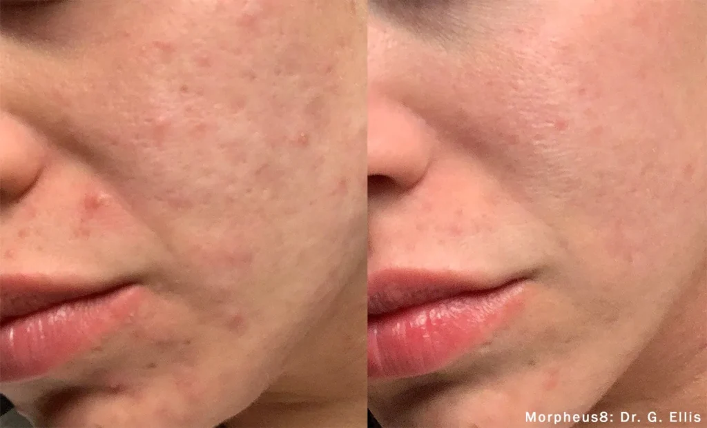 morpheus8 before after dr g ellis preview 1 5.webp