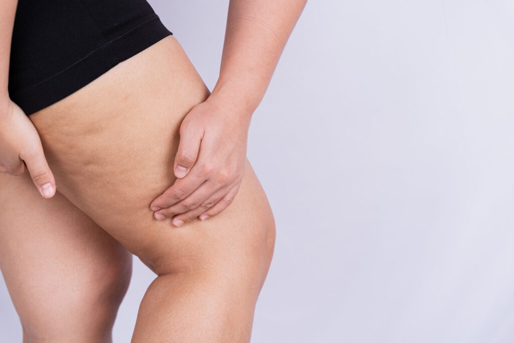 cellulite treatment
