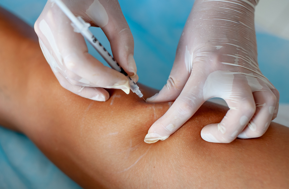 Sclerotherapy
