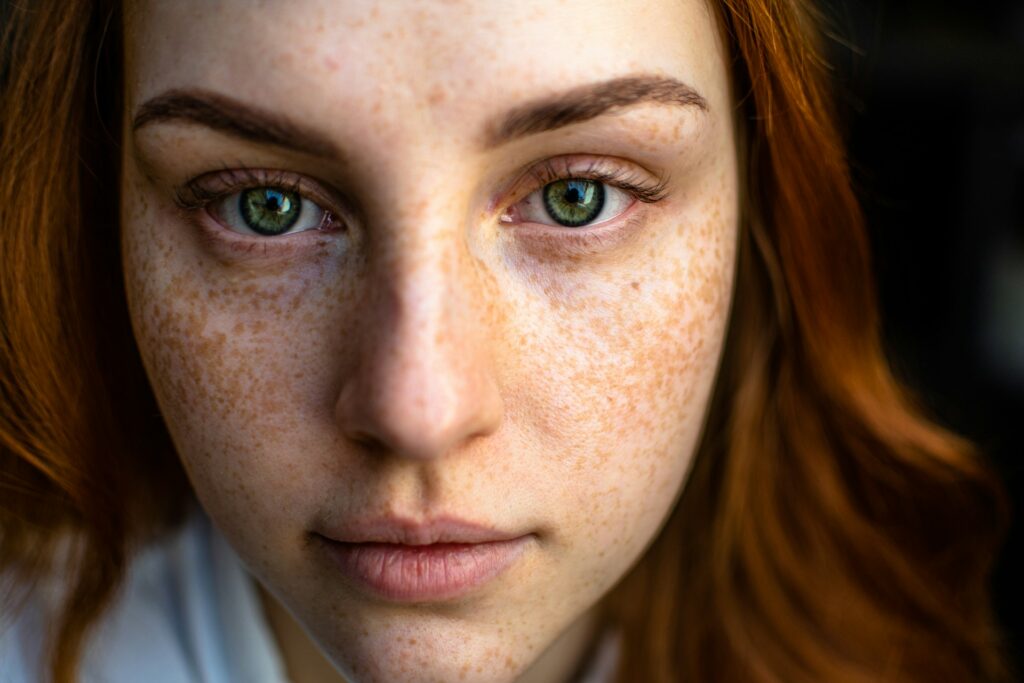 Hyperpigmentation in Eldersburg: Age-Based Causes and Treatment Differences 3 Hyperpigmentation
