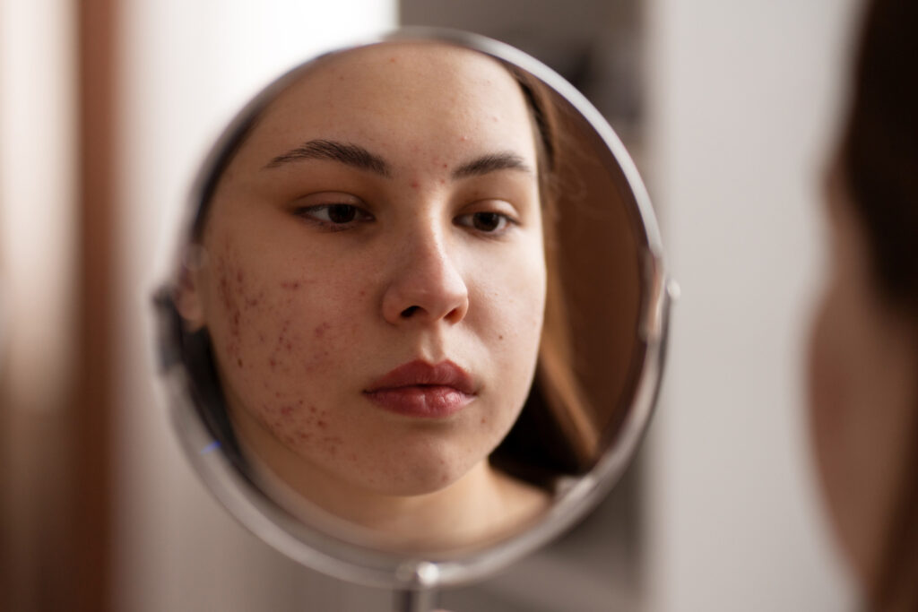 Acne Scar