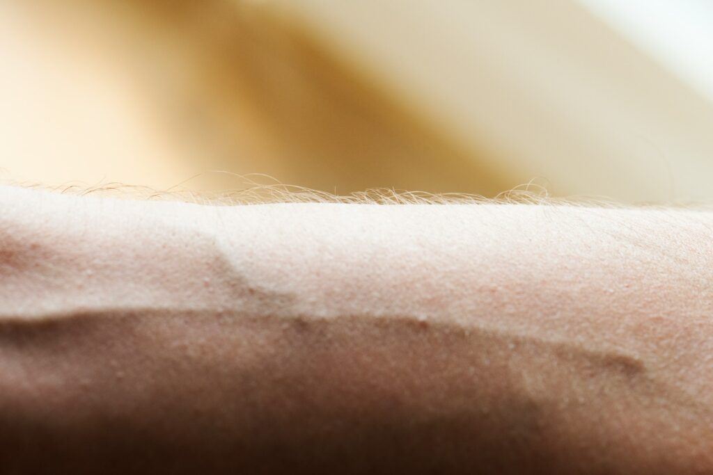 Spider Vein