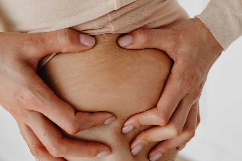 Cellulite