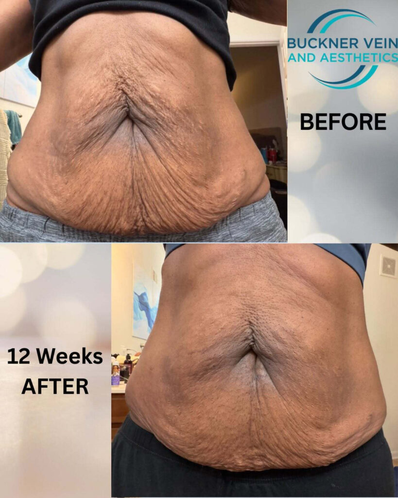 before and after quantum rf treatments