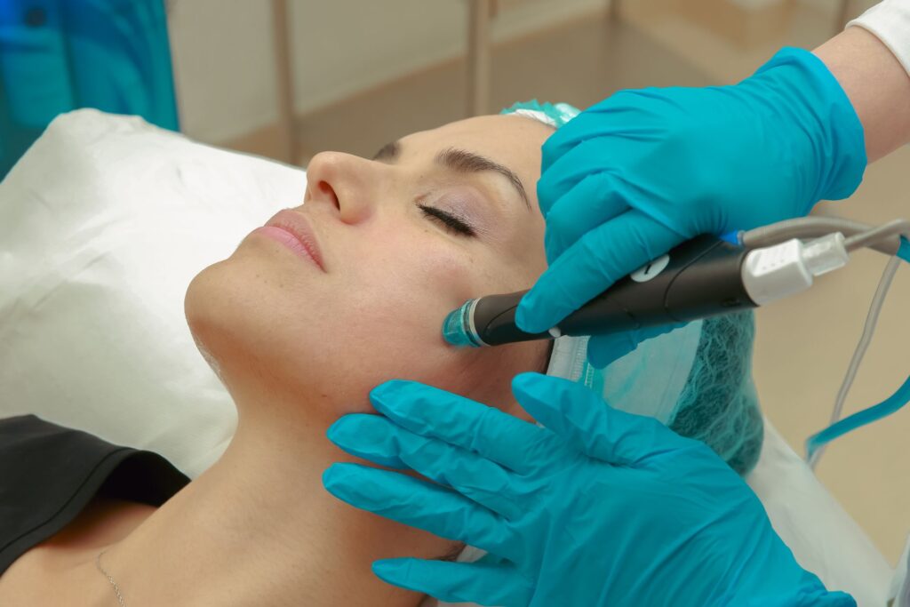 PRX Microneedling in Eldersburg: What It Feels Like and Aftercare 2 microneedling